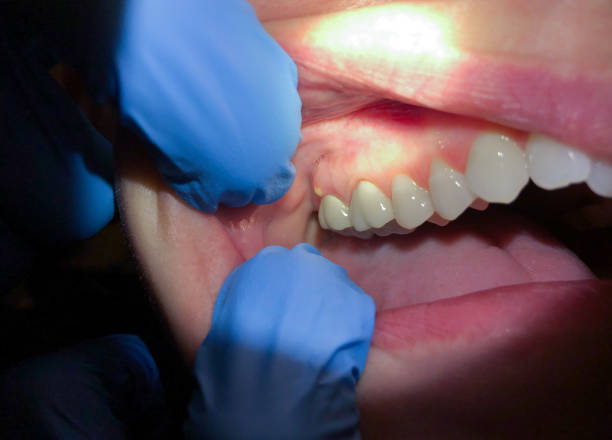 Best Broken or Cracked Tooth Emergency Dentist in Franconia, VA