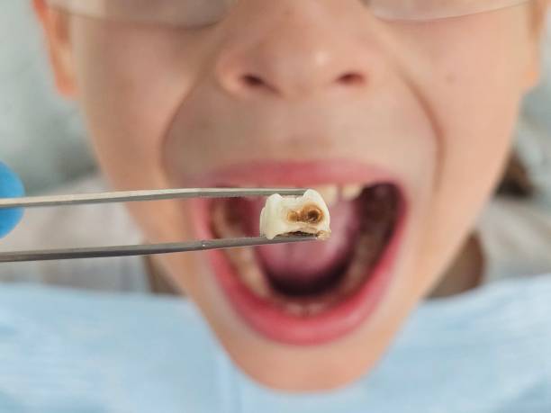 Best Emergency Dental Care for Abscessed Tooth in Franconia, VA